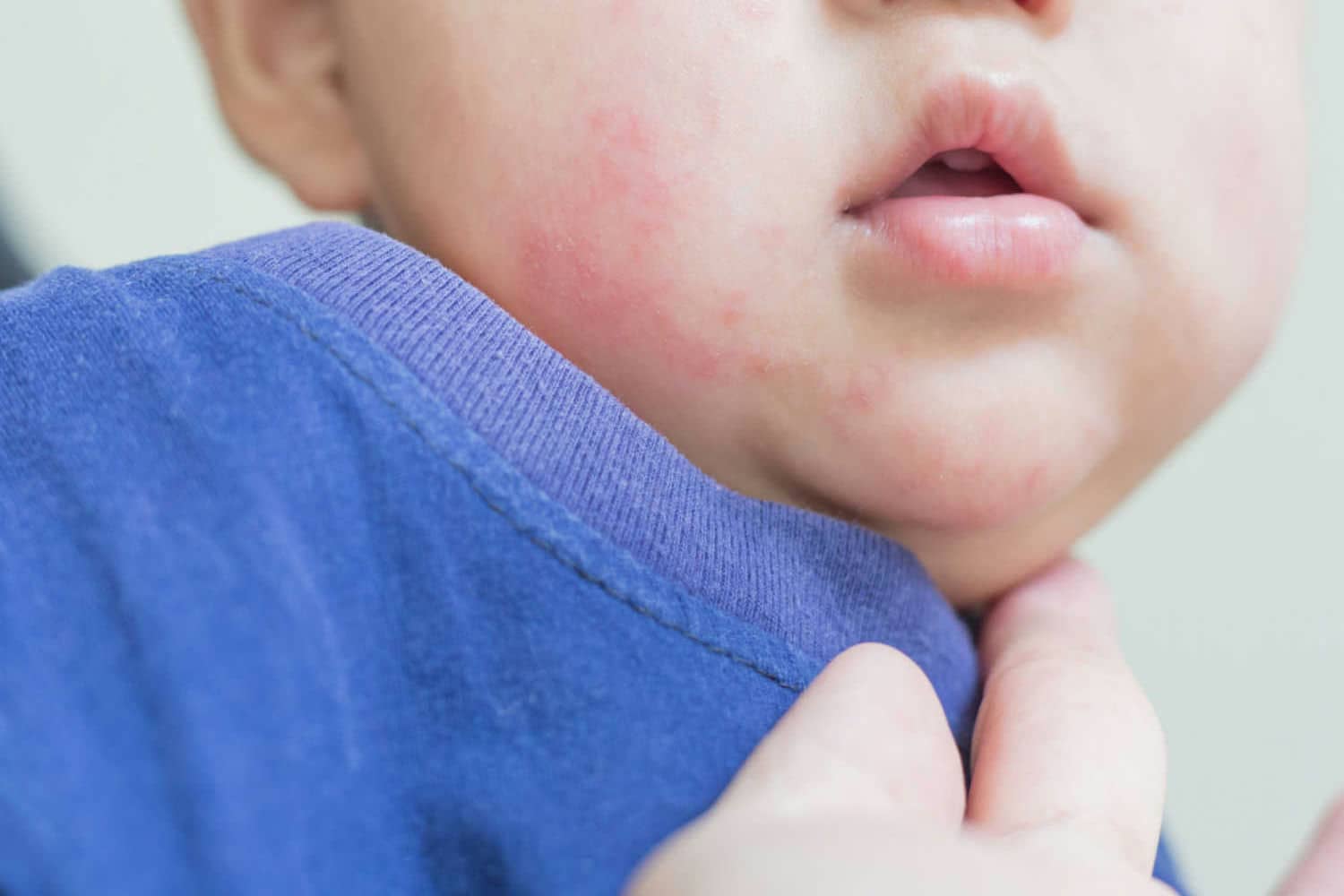 Is fungal infection in baby dangerous