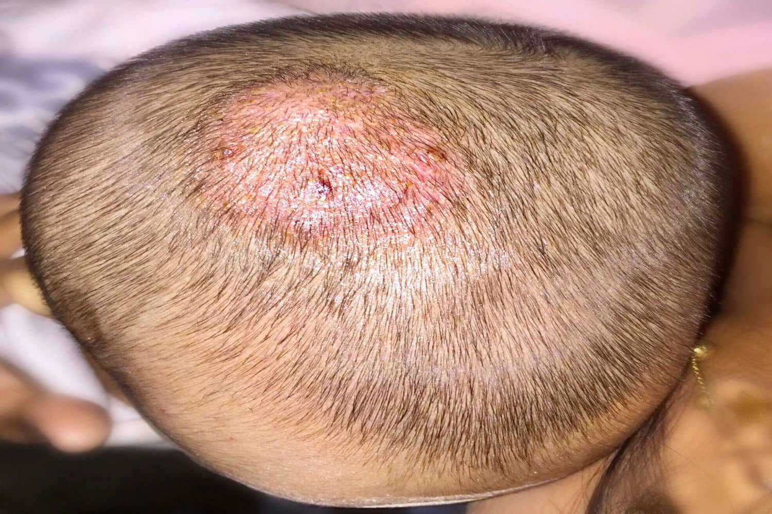 Fungal Skin Infection In Babies – Causes, Symptoms and Treatment - Being The Parent Fungal Skin Infection In Babies – Causes, Symptoms and Treatment - Being The Parent