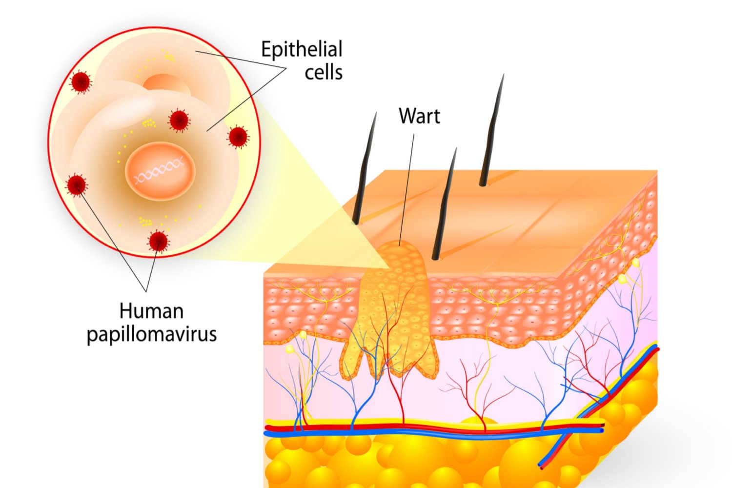 What Causes Warts_