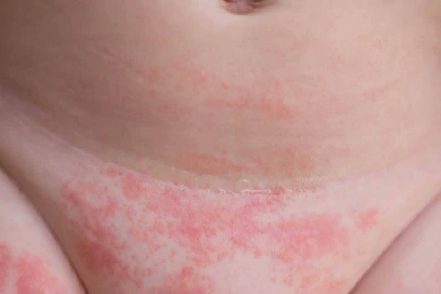 fungal infection in diaper area