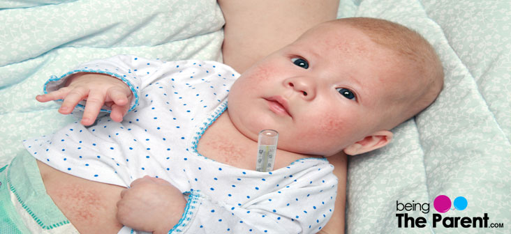 scarlet fever in babies