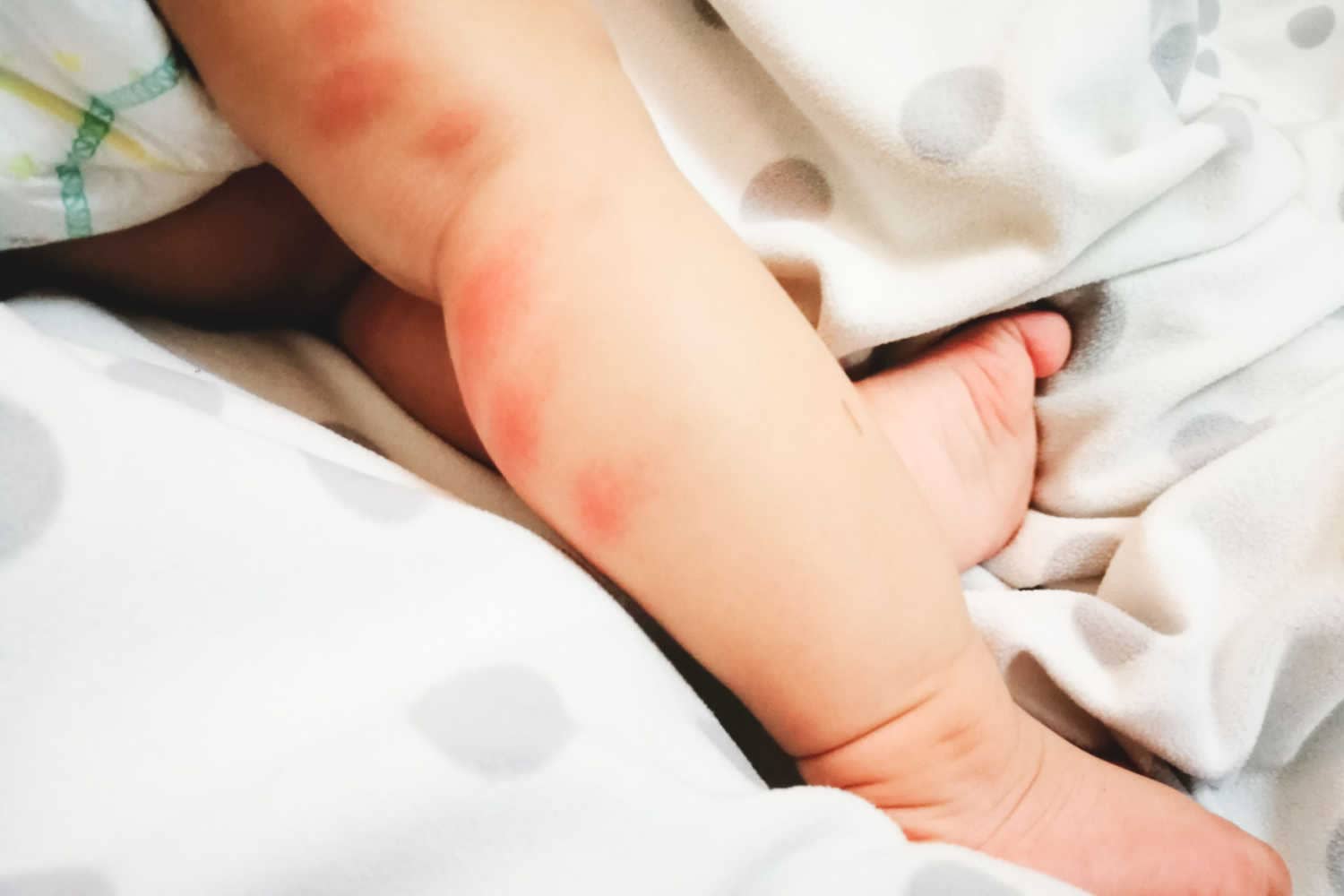 5 Effective Treatments To Cure Bug Bites In Babies Being The Parent