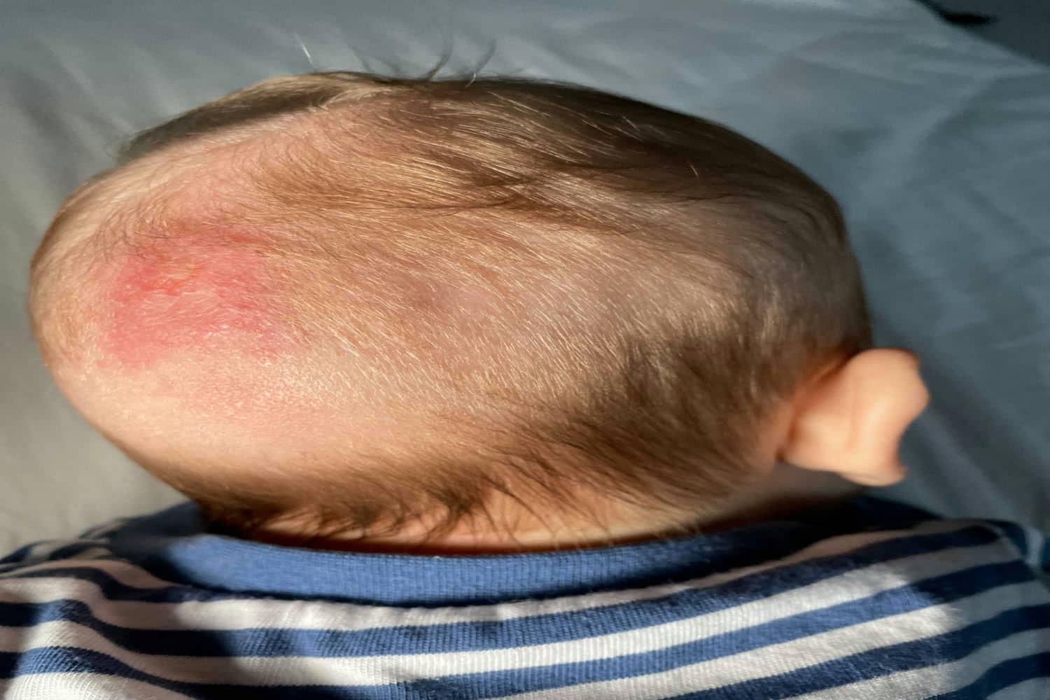 Ringworm In Babies Causes Symptoms And Treatment Being The Parent
