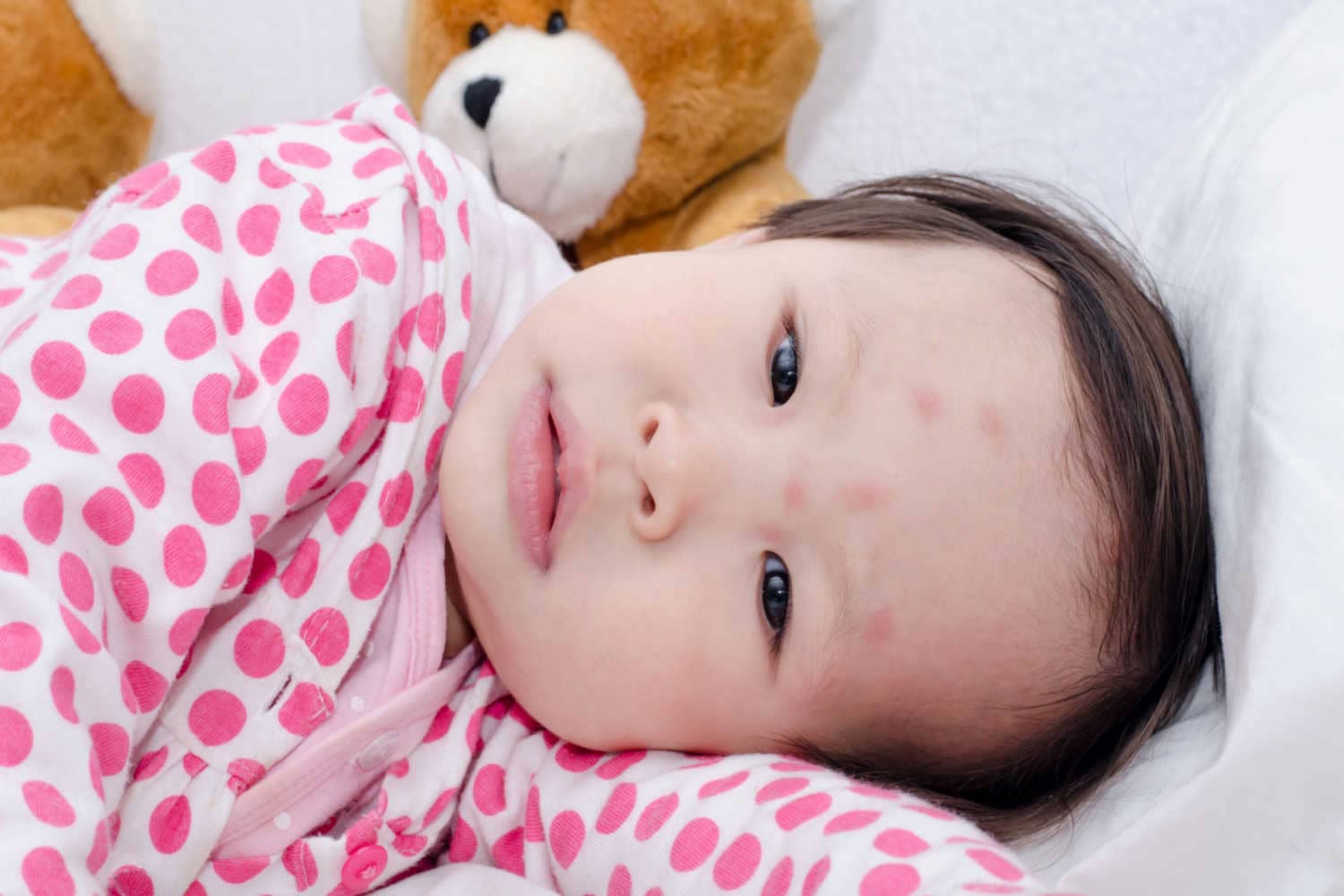 How To Treat Bug Bites In Babies_
