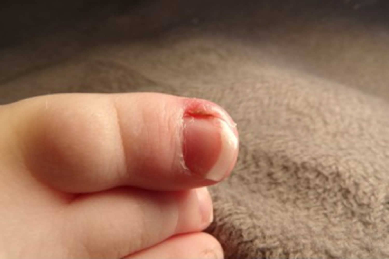 Ingrown toenails in babies Causes, Symptoms and Treatment Being The Parent