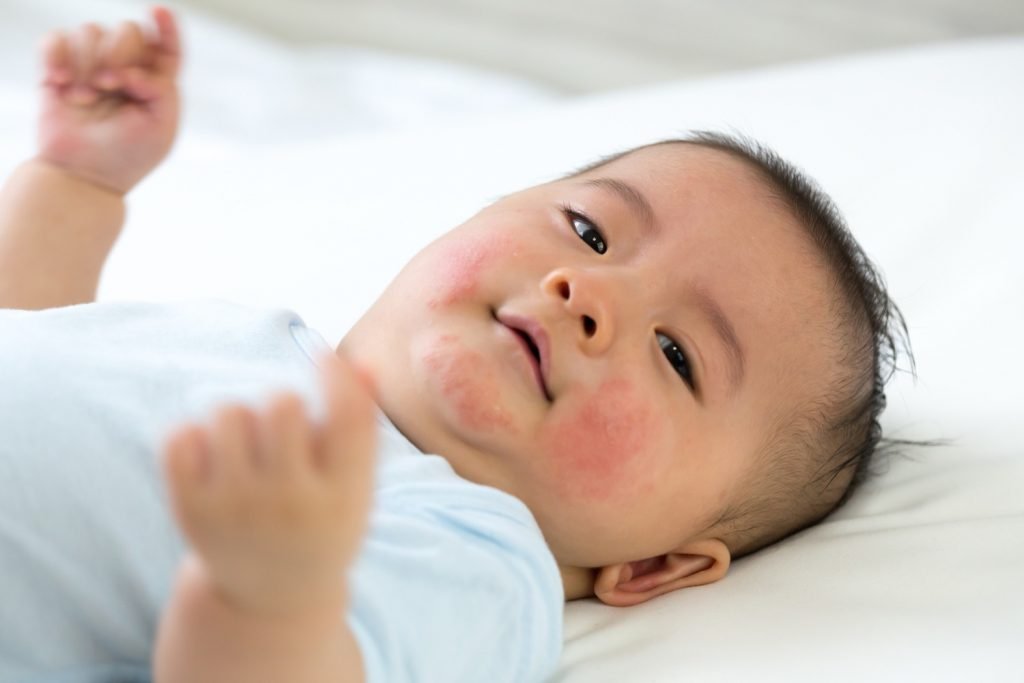 8 Common Skin Problems in Babies and Their Solutions Being The Parent
