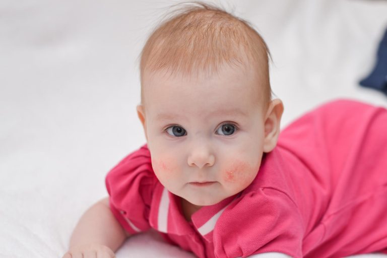 8 Common Skin Problems in Babies and Their Solutions Being The Parent