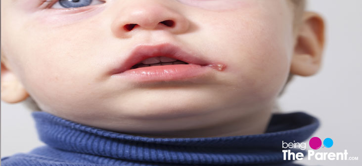 Cold Sores In Babies Symptoms Causes Treatment And Prevention