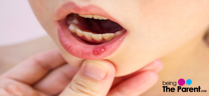 mouth ulcer in babies home remedy