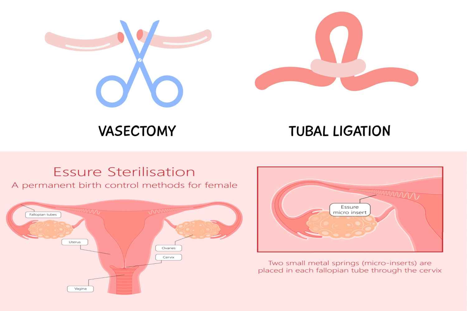 Sterilization or Permanent Contraception