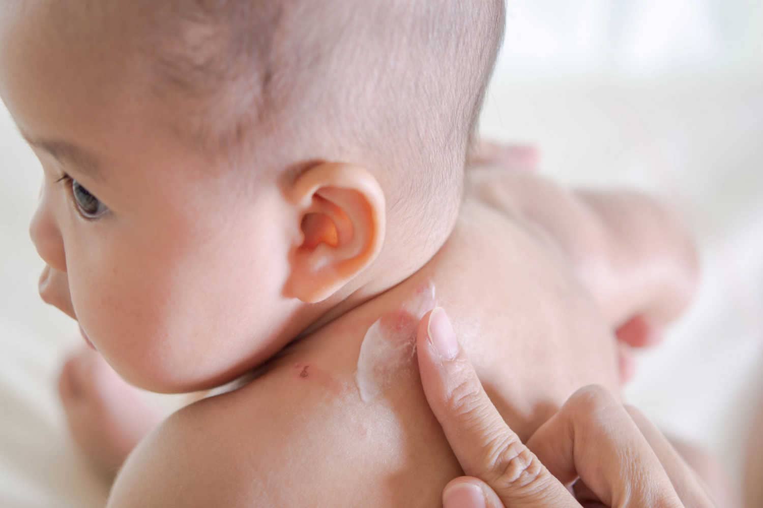 Remedies For Mosquito Bites and Stings in Infants