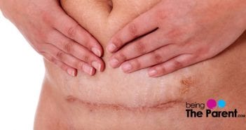How To Reduce Tummy After A C-Section? C section belly