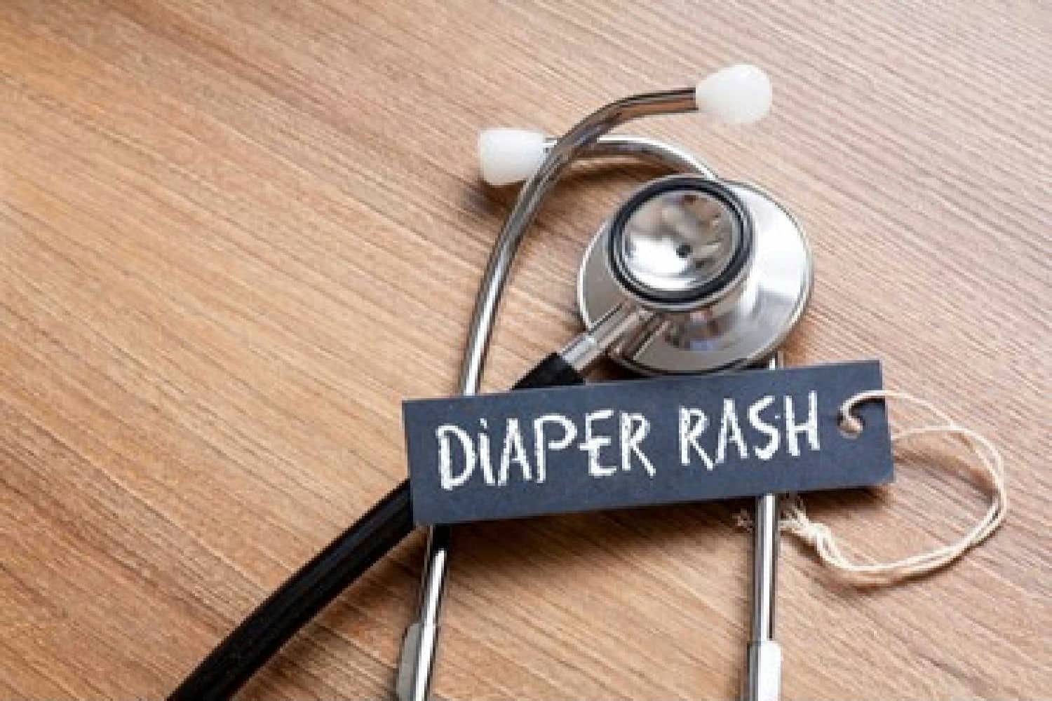 Diaper Rashes - Causes, Treatment, Home Remedies and Precautions.