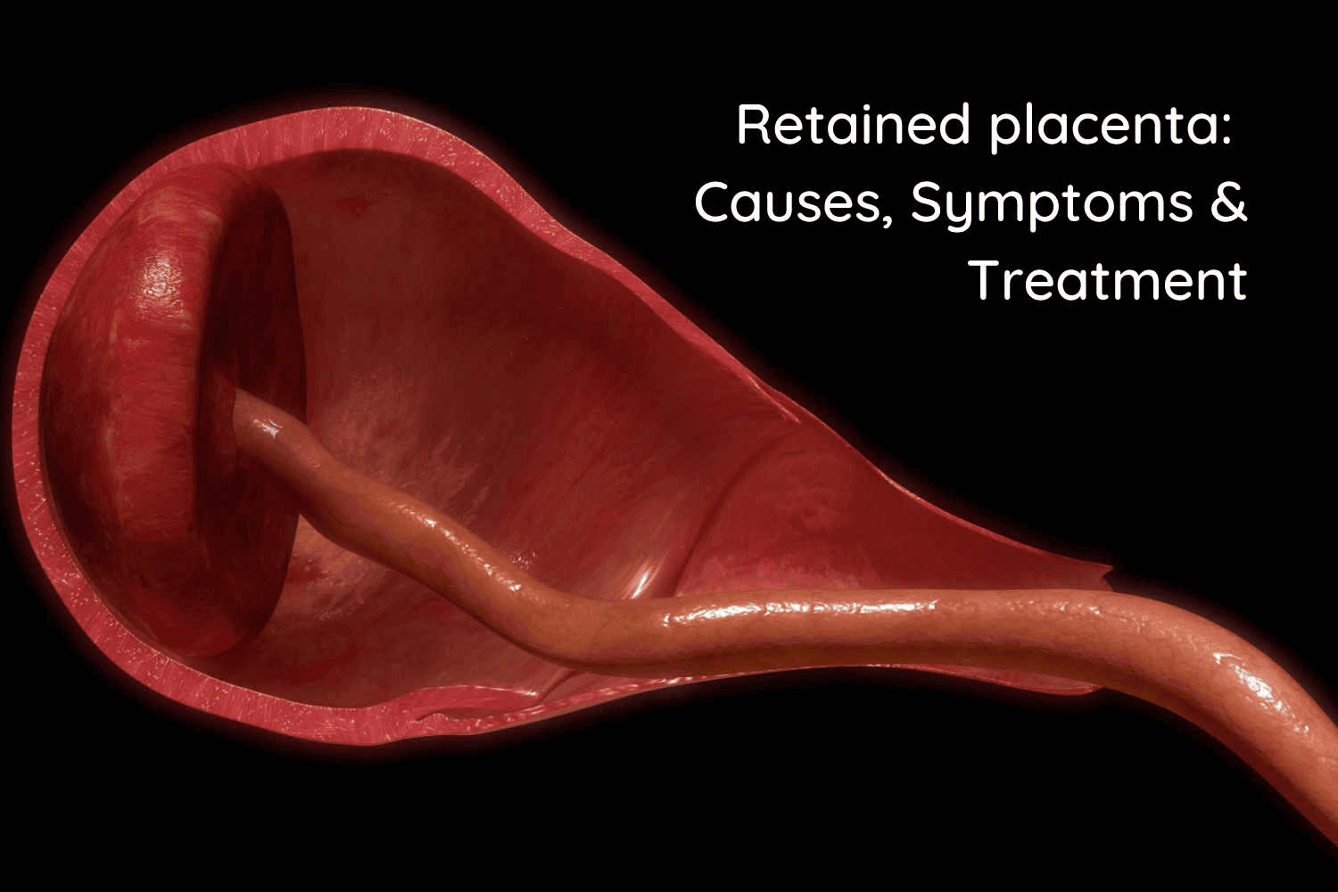 Retained Placenta: Causes, Symptoms And Treatment - Being The Parent
