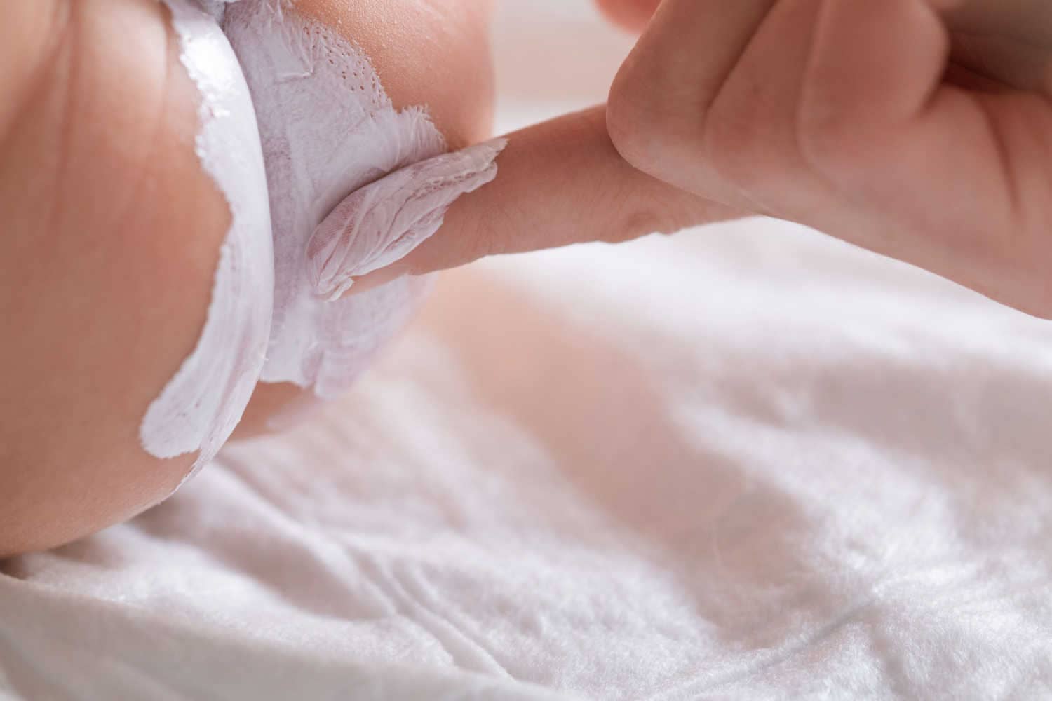 Treating diaper rash