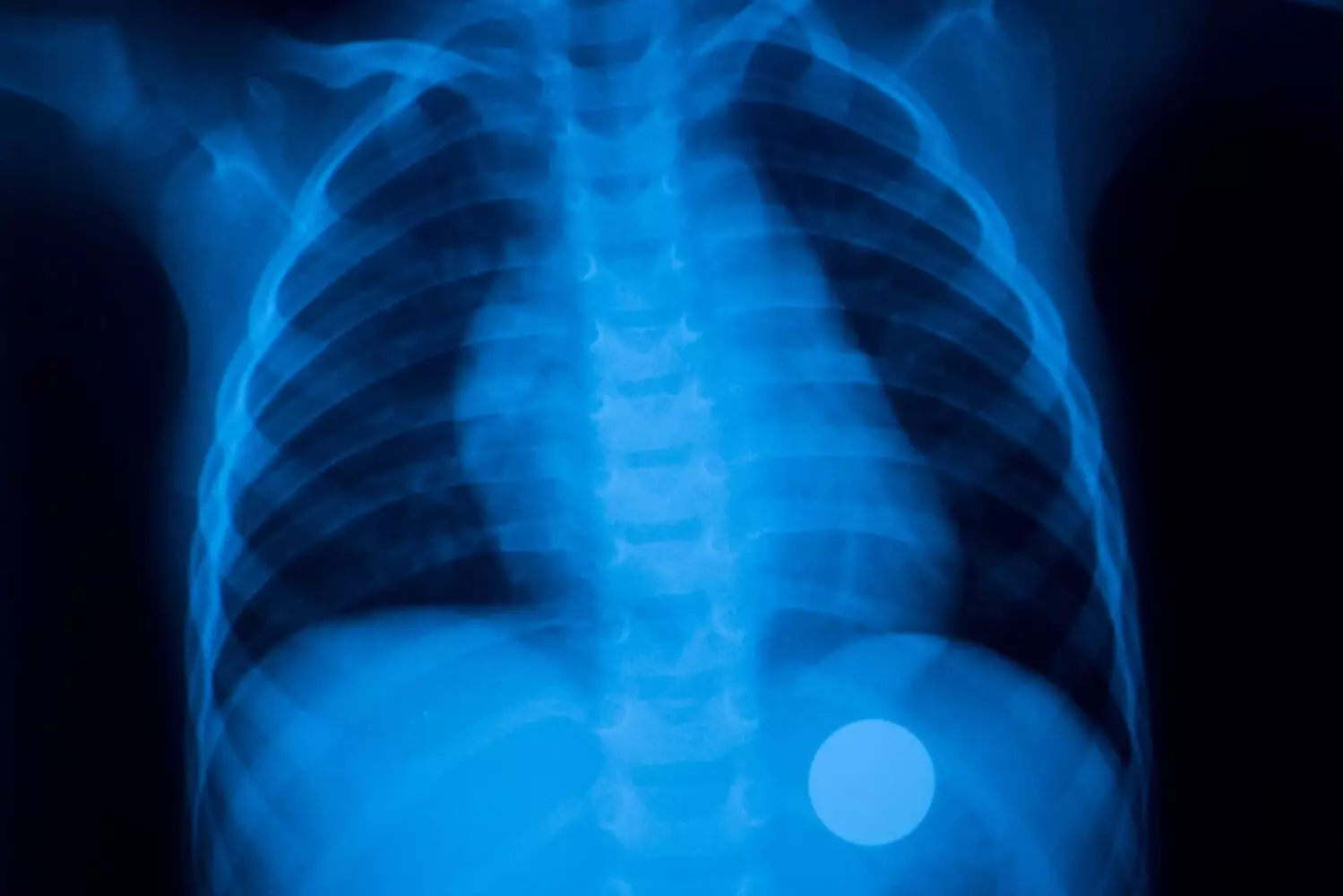 Xray of child swallowed coin
