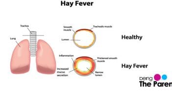 Hay Fever In Babies hay fever