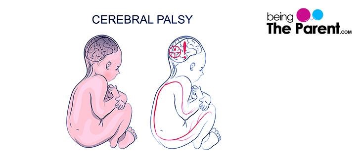 early-signs-of-cerebral-palsy