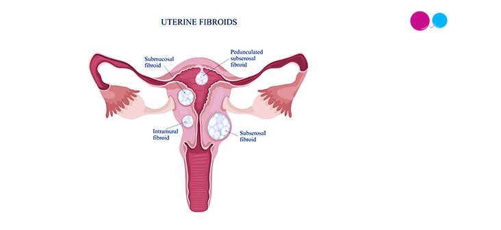 facts-about-miscarriage