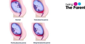 Placenta Previa Bleeding in Pregnancy placenta-previa-bleeding