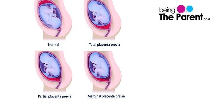 placenta-previa-types