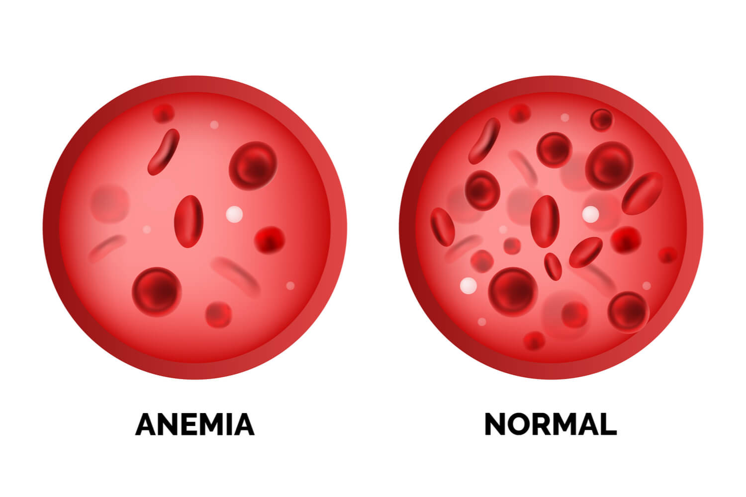 Iron-deficiency Anemia