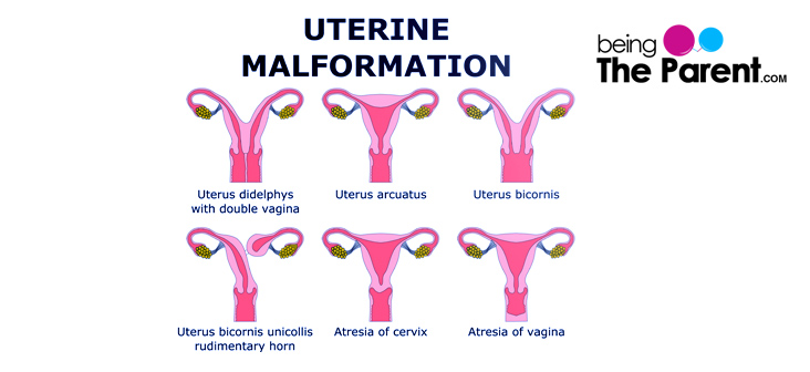 Uterine Didelphys in a Pregnant Mother