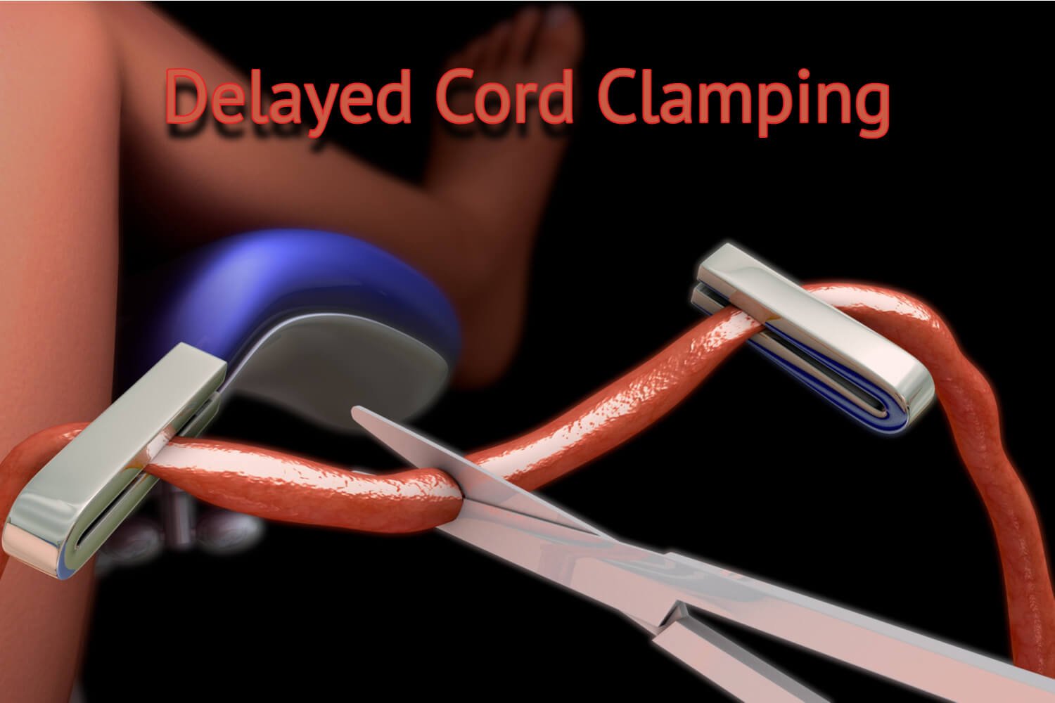 Delayed Cord Clamping A Comprehensive Guide by Dr Lathiesh Kumar