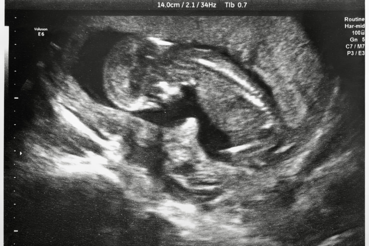 9th month pregnancy scan