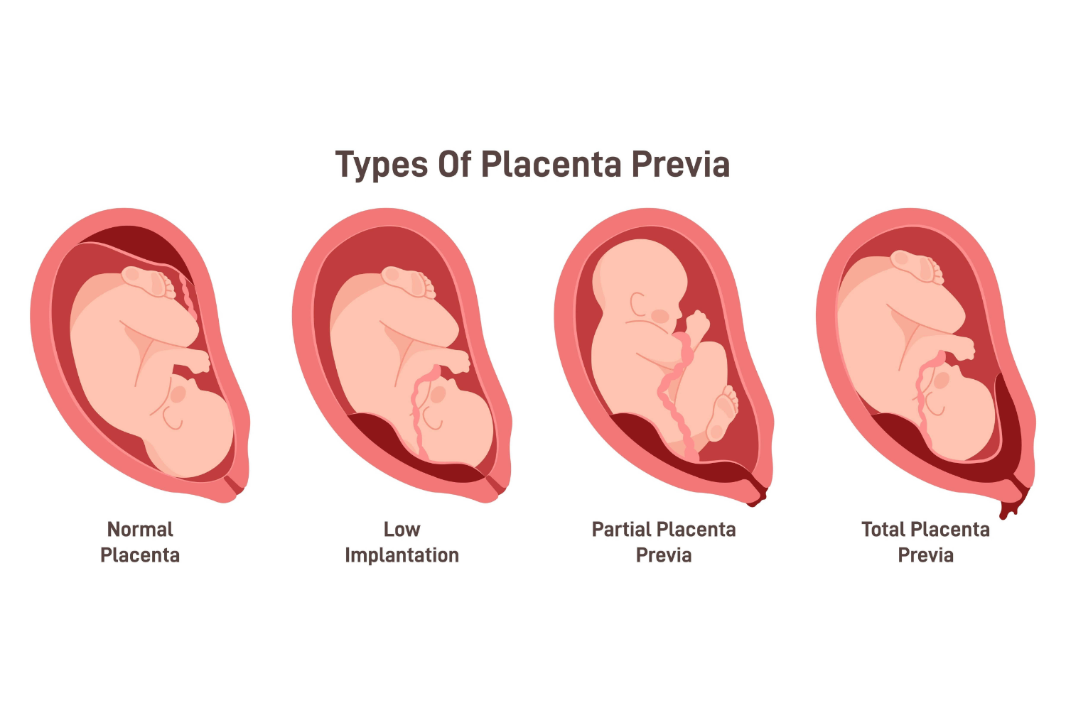 Placenta Previa Symptoms, Causes And Treatment Being The Parent
