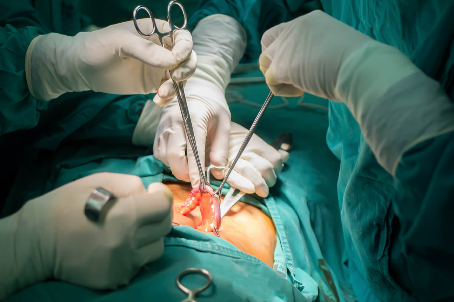 appendectomy surgery