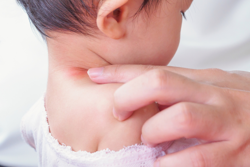 Baby Neck Rash