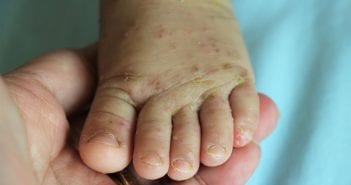 Scabies In Babies: Causes, Symptoms And Treatment Scabies in Babies