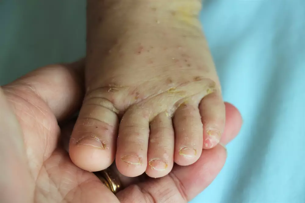Scabies In Babies Causes Symptoms And Treatment Being The Parent