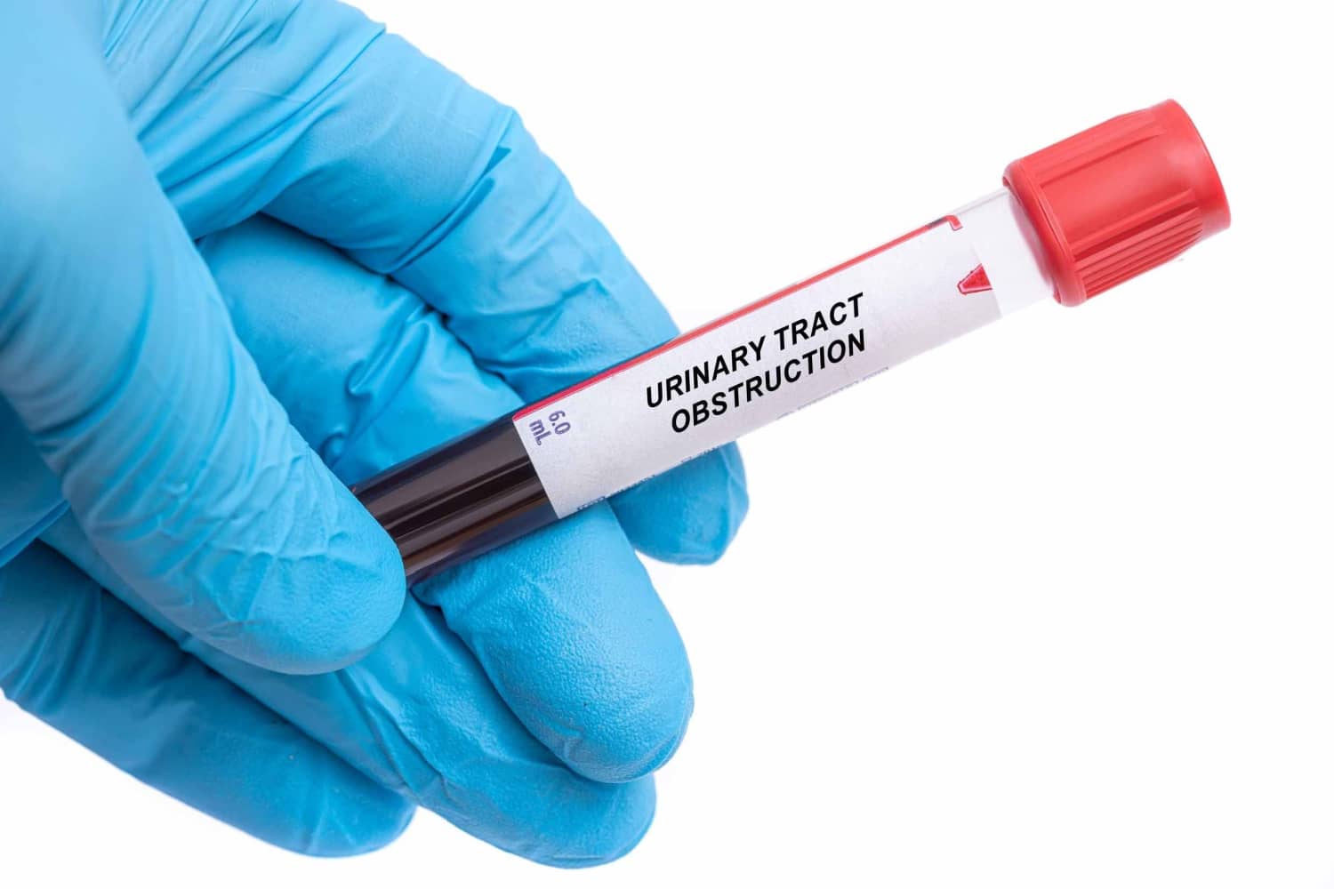 Urinary tract obstruction.