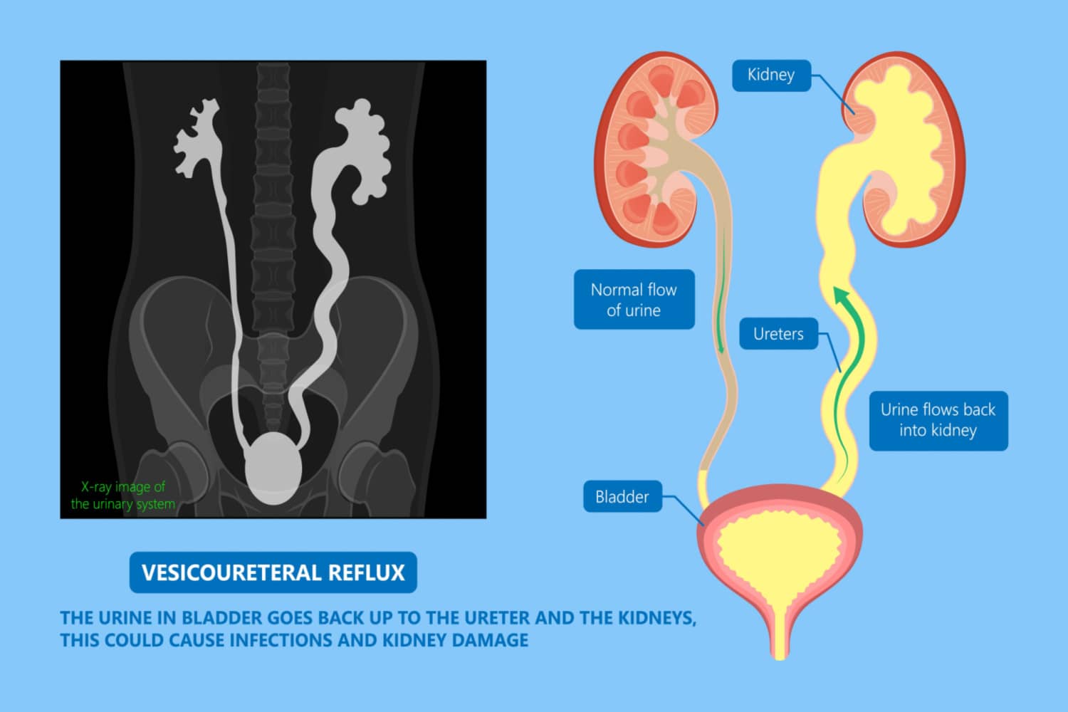Vesicoureteral Reflux