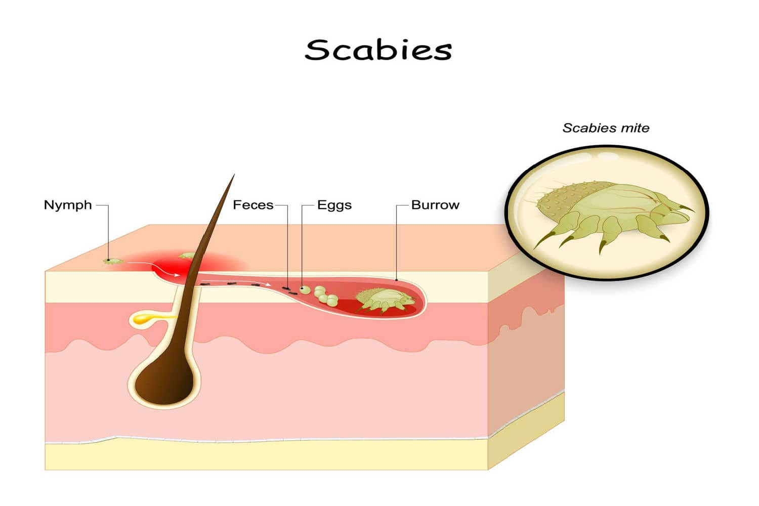 Scabies In Babies Causes, Symptoms And Treatment Being The Parent
