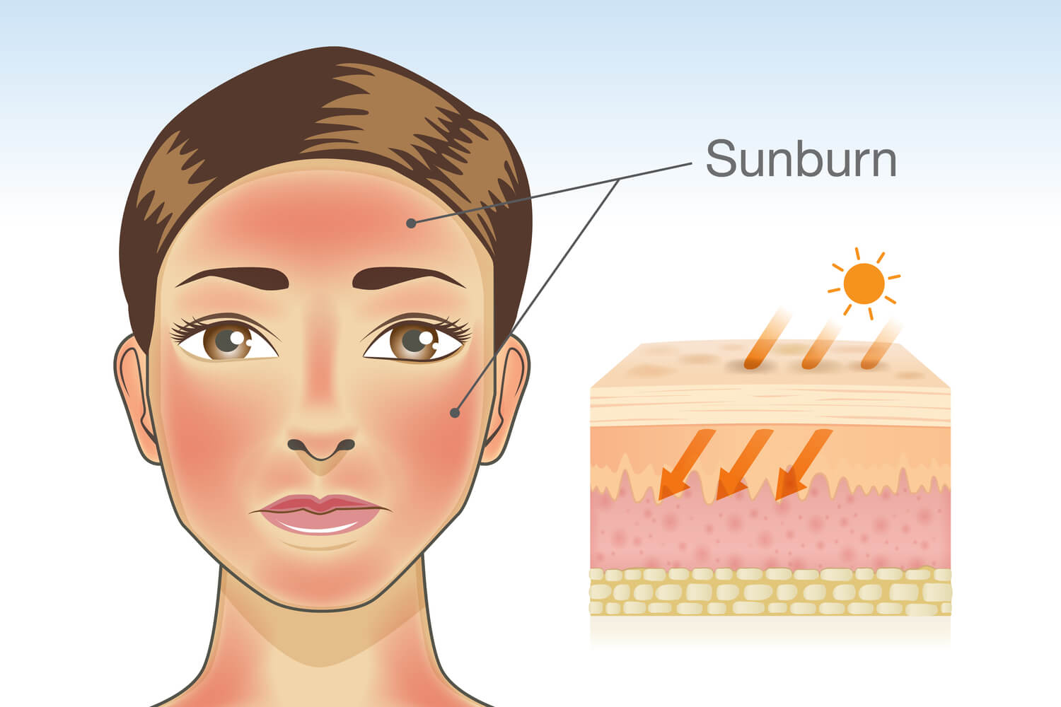 Symptoms of Sunburn in Babies
