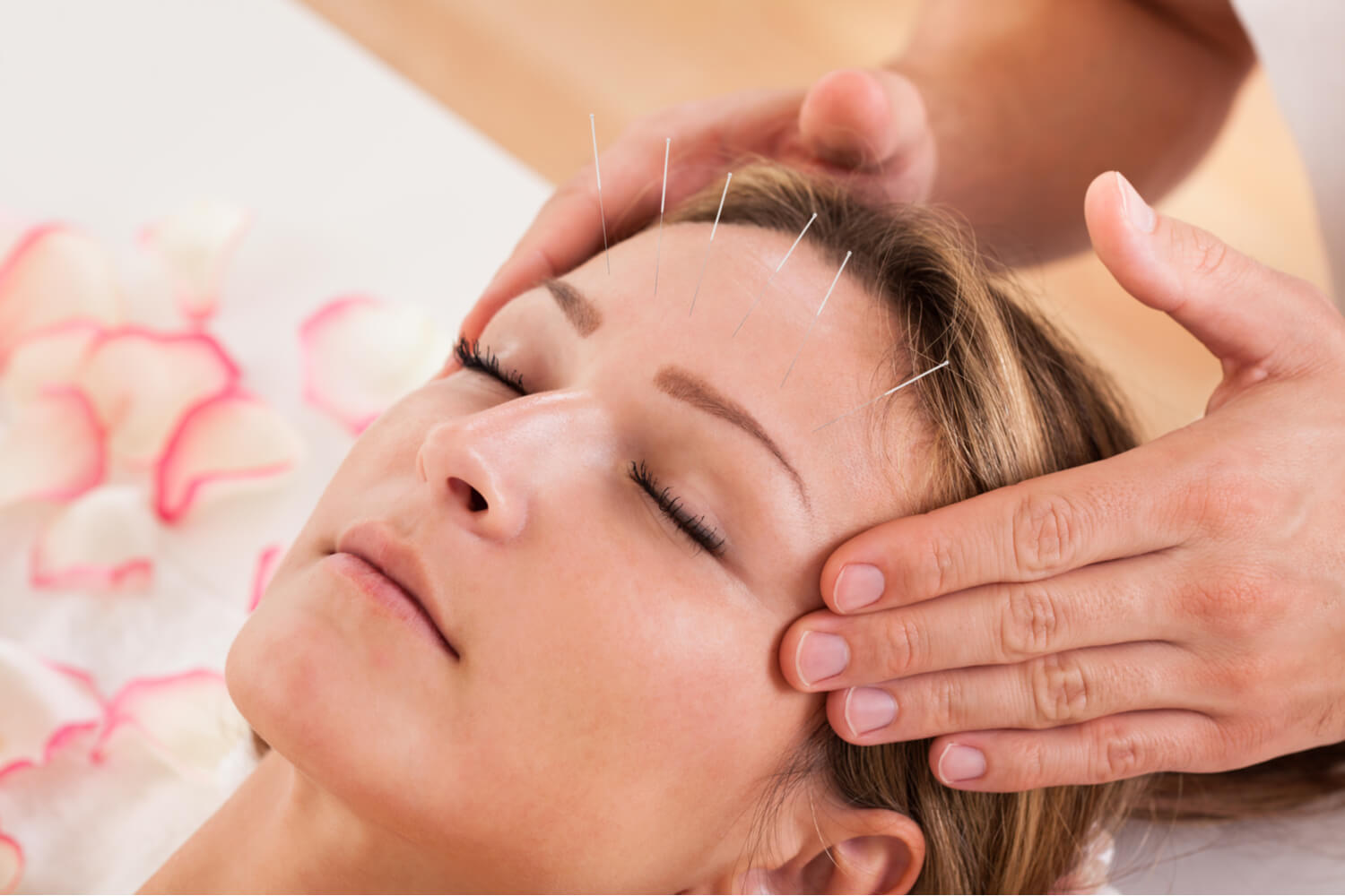 pregnant women getting Acupuncture