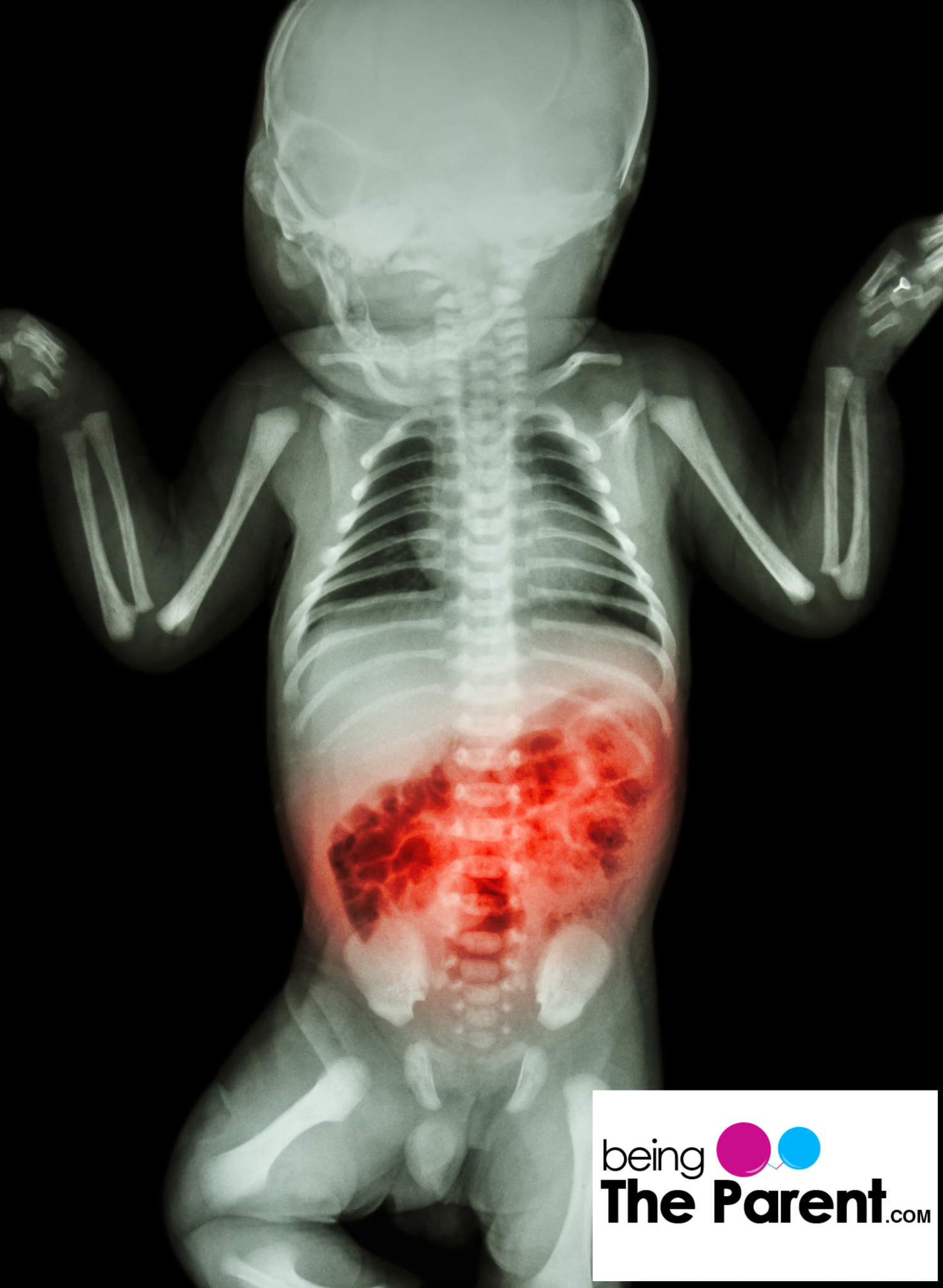 Necrotizing Enterocolitis Causes, Symptoms, and Treatment Being The