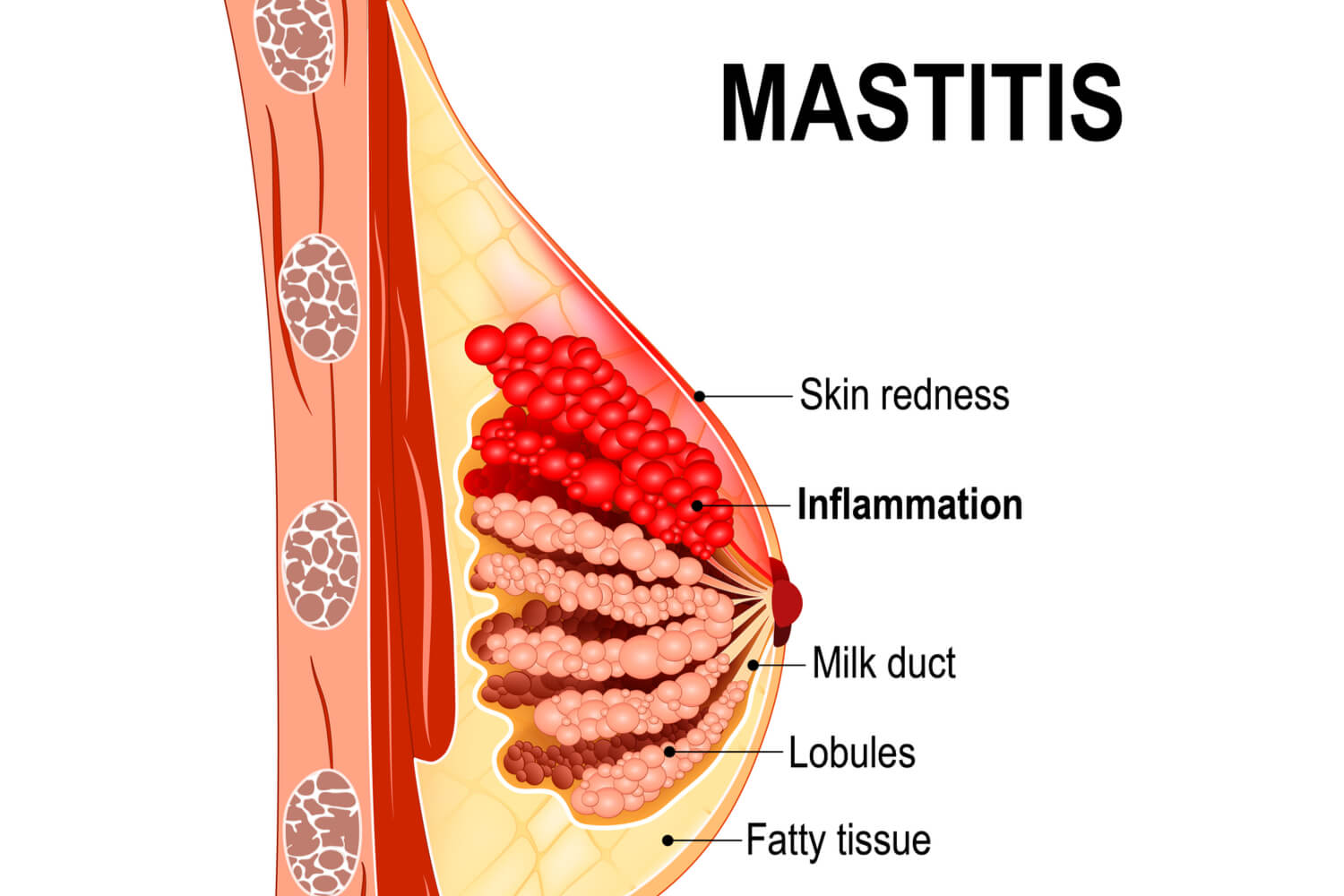 what causes mastitis