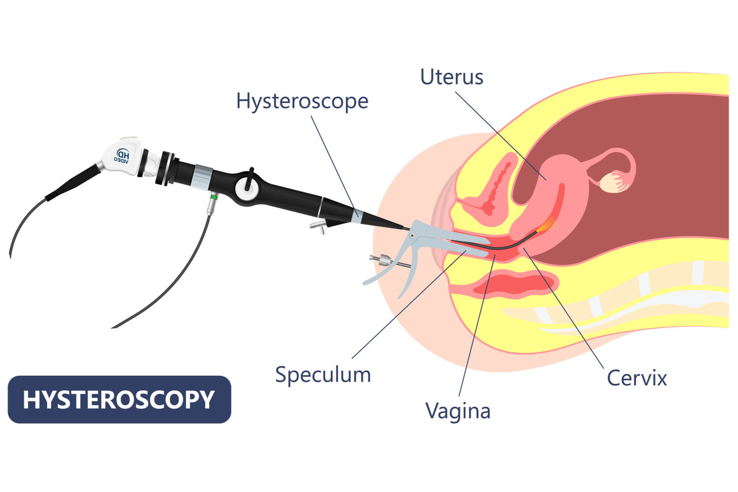 Hysteroscopy diagram