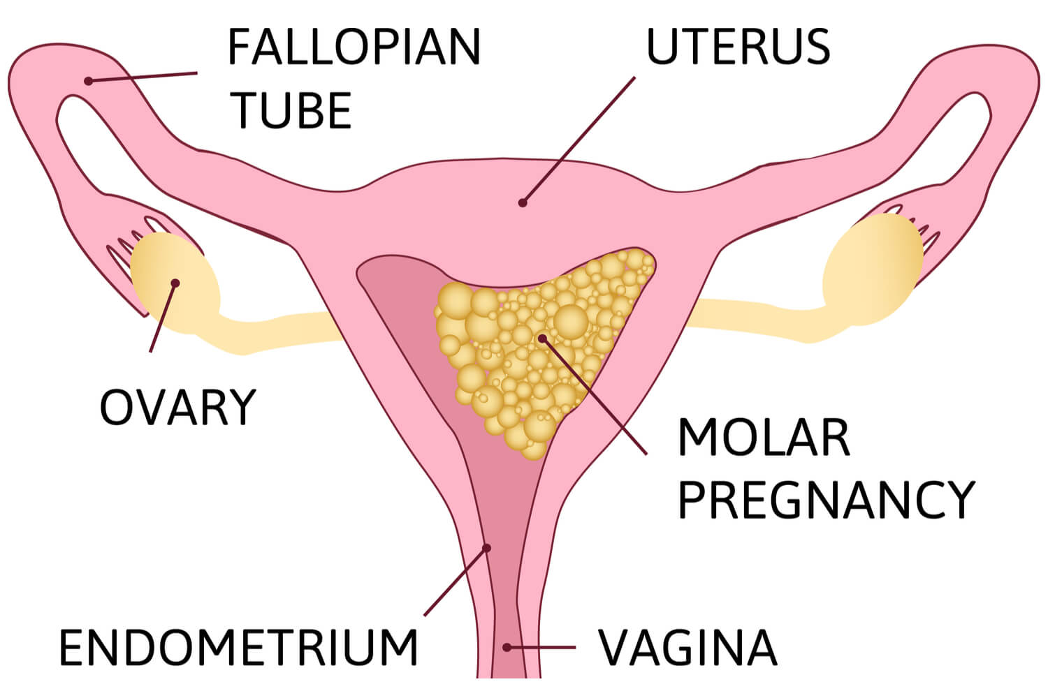 molar pregnancy