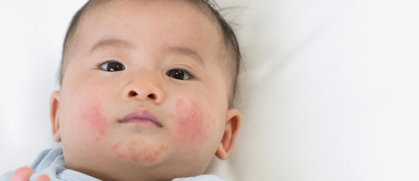 8 Ways To Treat Drool Rash In Babies