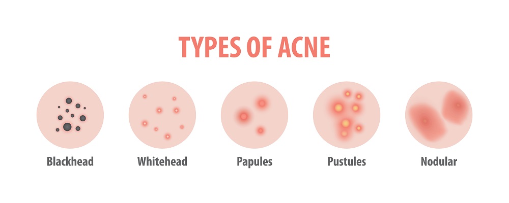 teenage acne natural remedies