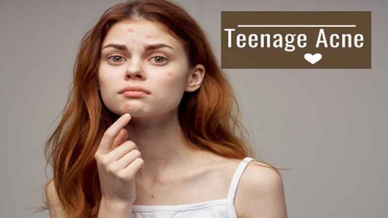 teenage acne