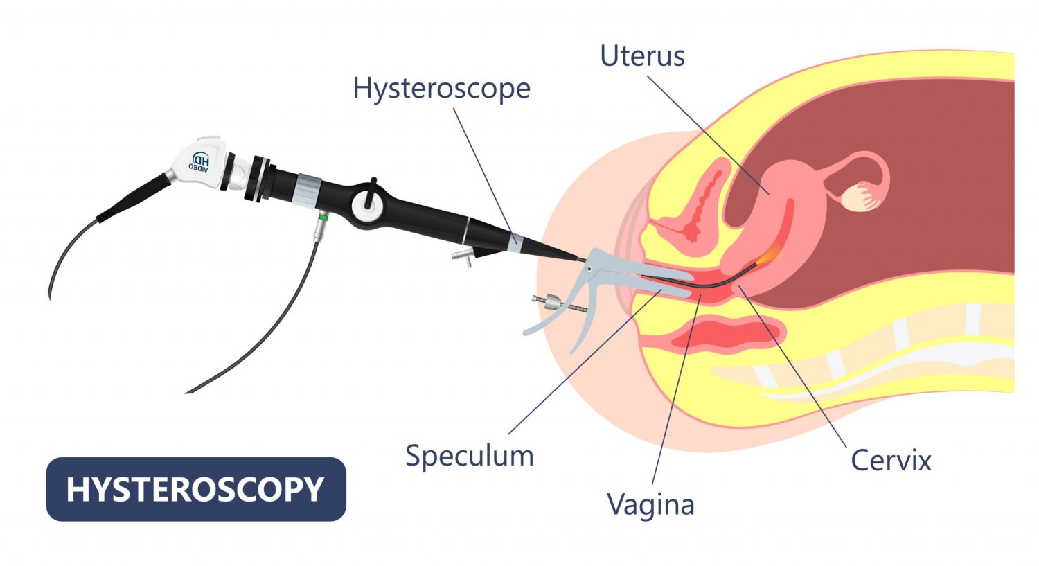 hysteroscopy