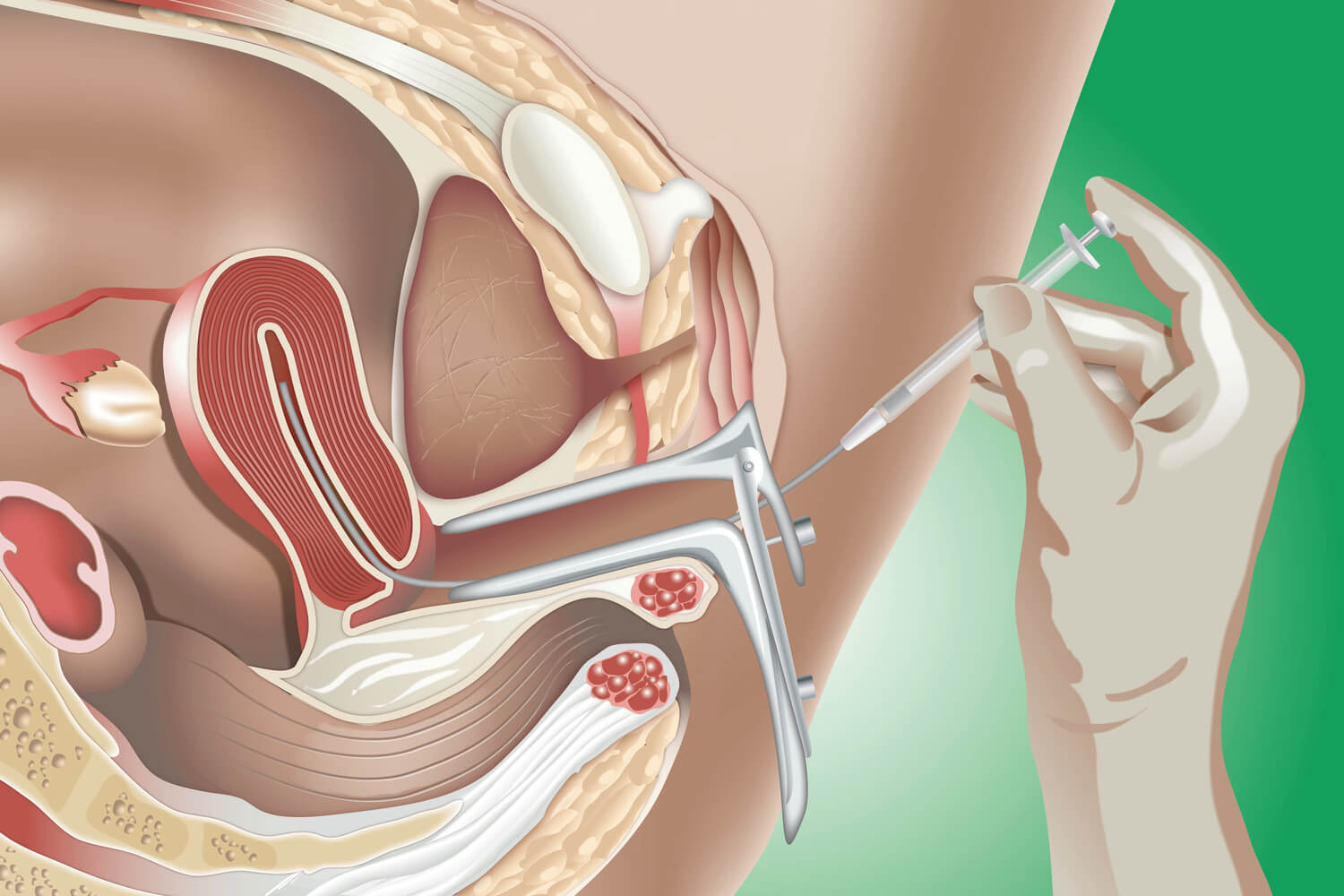 insemination injection in vagina