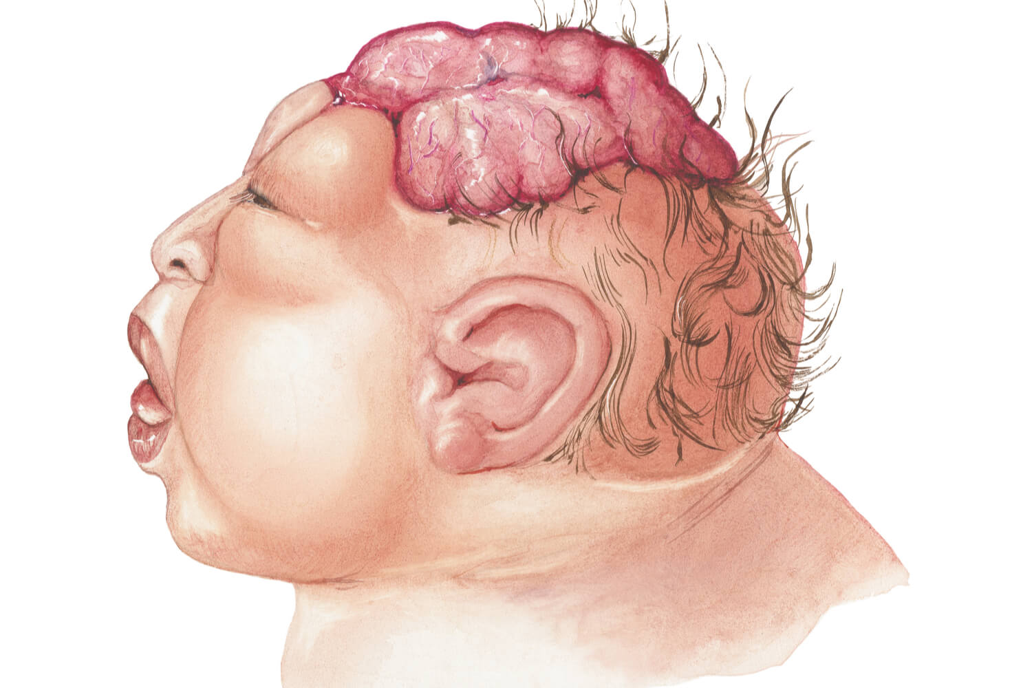 anencephalic baby