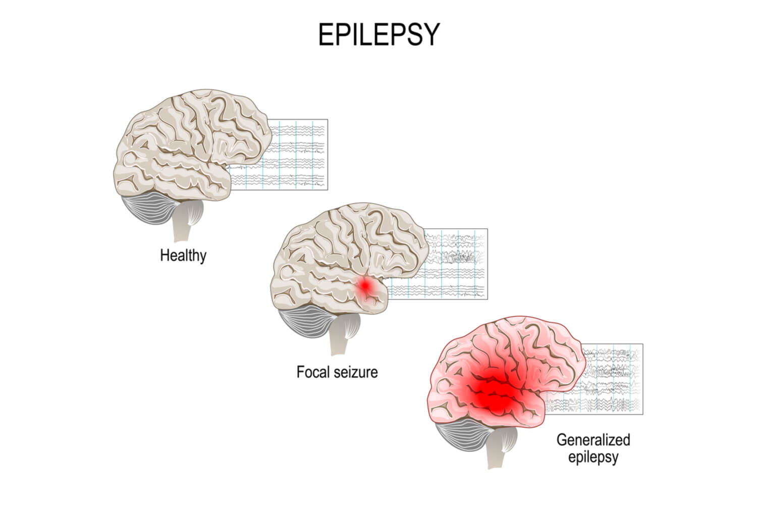 infant epilepsy